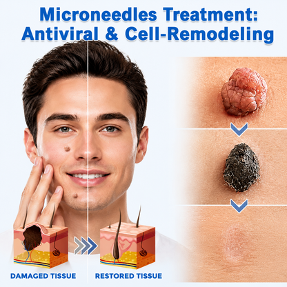 🔥 LAST DAY SALE-80% OFF ✨Curalona®2-in-1 Microneedle & Hydrocolloid Patch🍀| Removes Raised Moles, Acne, Flat Warts & Skin Tags | Helps Improve Wrinkles, Scars & Blemishes | Invisible Patches for Face & Body