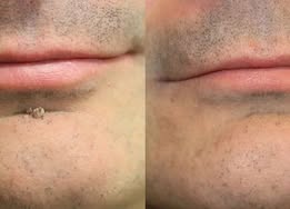🔥 LAST DAY SALE-80% OFF ✨Curalona®2-in-1 Microneedle & Hydrocolloid Patch🍀| Removes Raised Moles, Acne, Flat Warts & Skin Tags | Helps Improve Wrinkles, Scars & Blemishes | Invisible Patches for Face & Body