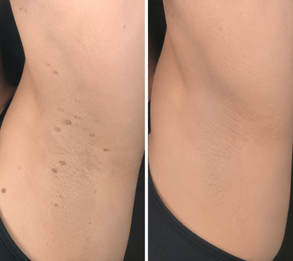 🔥 LAST DAY SALE-80% OFF ✨Curalona®2-in-1 Microneedle & Hydrocolloid Patch🍀| Removes Raised Moles, Acne, Flat Warts & Skin Tags | Helps Improve Wrinkles, Scars & Blemishes | Invisible Patches for Face & Body