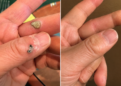 🔥 LAST DAY SALE-80% OFF ✨Curalona®2-in-1 Microneedle & Hydrocolloid Patch🍀| Removes Raised Moles, Acne, Flat Warts & Skin Tags | Helps Improve Wrinkles, Scars & Blemishes | Invisible Patches for Face & Body